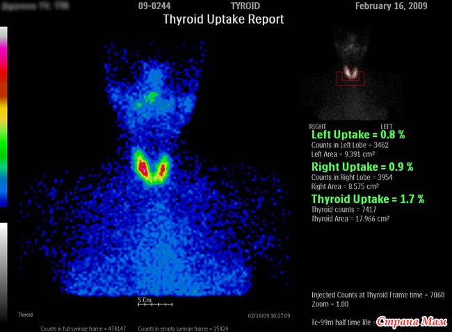 Сцинтиграфия щитовидной железы картинки
