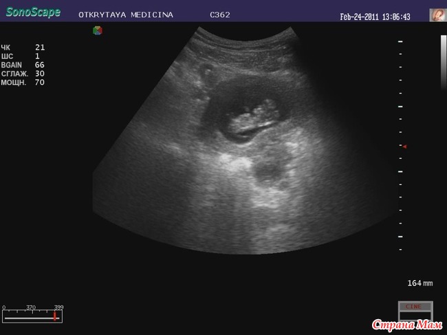 Узи скрининг 1 триместра. Узи плода 12 акушерских недель беременности. На каких неделях делают узи. Узи скрининг 1 триместра как делают. На каких неделях делают узи.