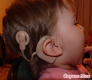 Мой ребенок глухой. Делать ли Кохлеарную имплантацию?