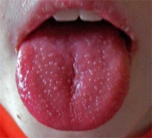 Глоссит (воспаление языка) у ребенка