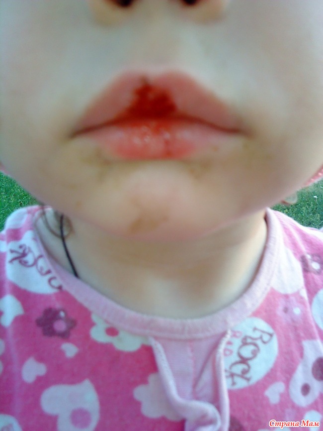 Обветривание губ у ребенка: как избежать неприятностей?