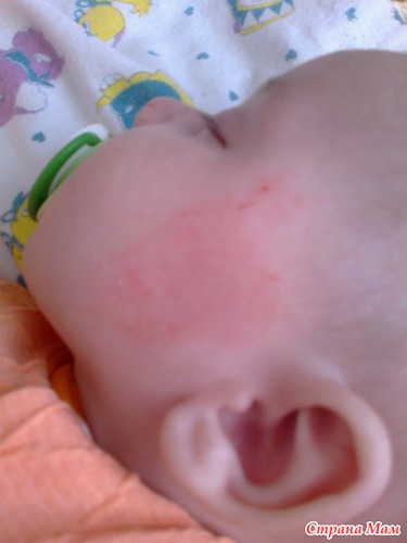 Аллергия на смесь у ребенка