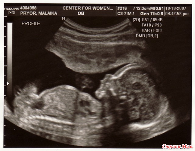 21 неделя беременности: фото УЗИ