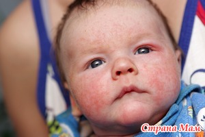 Поражения кожи при детских инфекциях. Как отличать?
