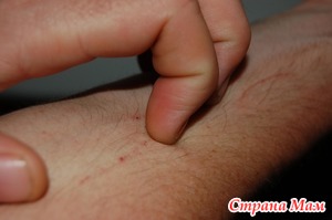 Грибковые и паразитарные болезни кожи у детей