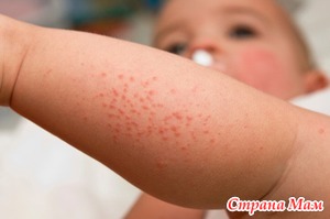 Аллергические реакции на коже у детей