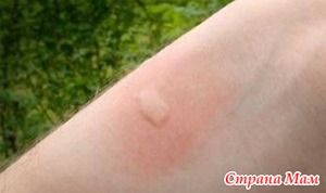Аллергия на укусы насекомых.Типы реакции.