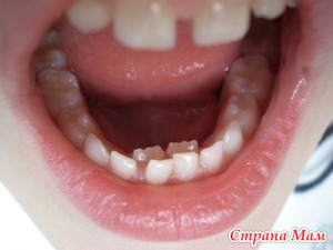 Смена зубов у детей: постоянный прикус