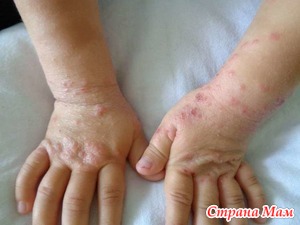Натуральные средства в лечении дерматита