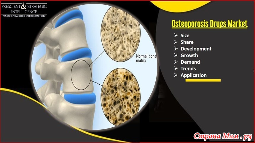 Bone loss. Zero Bone loss Concept. Drugs marketing HPV.