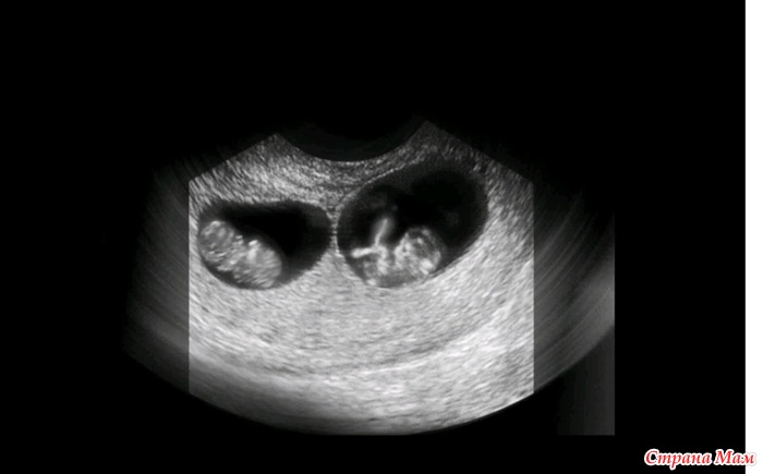 Фото двойни на узи 7 недель беременности