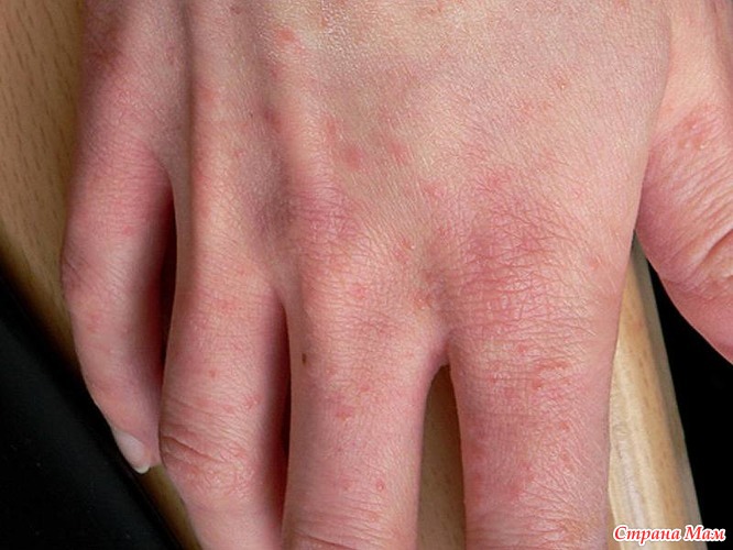 Трещины на коже рук: как спасти руки от трещин на коже